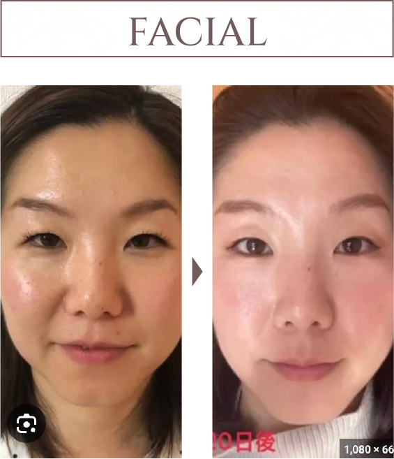 FACIAL